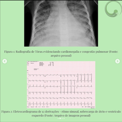 rx torax ecg caso clinico miocardiopatia dilatada wavesmed