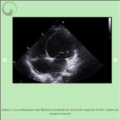 Ecocardiograma caso clinico miocardiopatia dilatada wavesmed