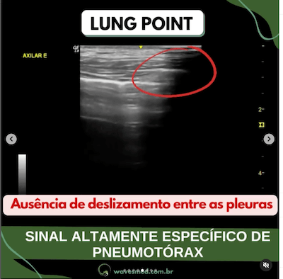 Deslizamento pleuras pneumotórax usg tórax emergência wavesmed