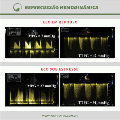 Doppler eco estresse estenose mitral wavesmed