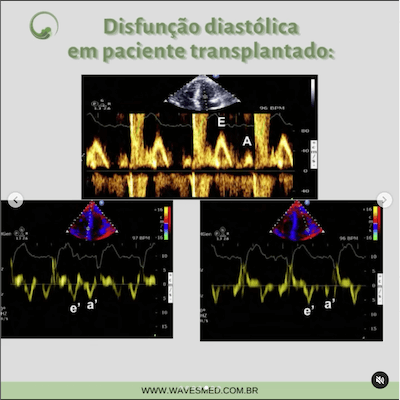 Doppler função diastólica no transplante cardíaco wavesmed