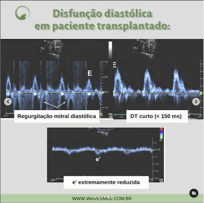 Regurgitação mitral função diastólica no transplante cardíaco wavesmed