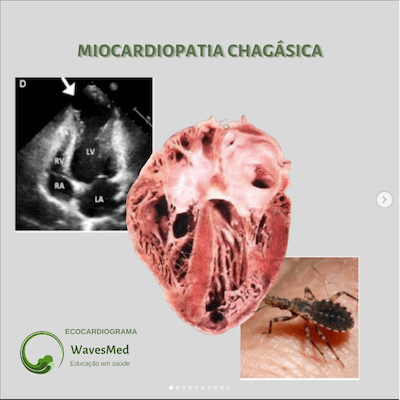 Ecocardiografia miocardiopatia chagásica wavesmed