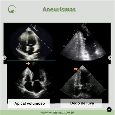 Aneurismas ecocardiografia miocardiopatia chagásica wavesmed