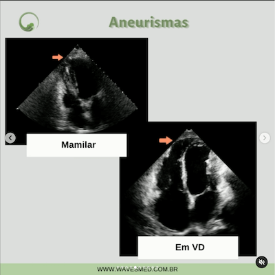 Aneurisma vd ecocardiografia miocardiopatia chagásica wavesmed