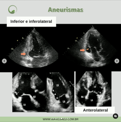 Aneurisma inferior ecocardiografia miocardiopatia chagásica wavesmed