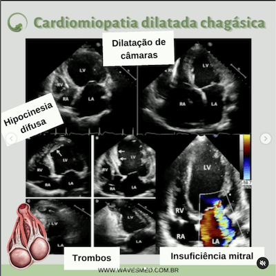 Dilatada câmaras ecocardiografia miocardiopatia chagásica wavesmed