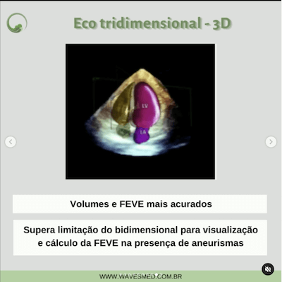 Eco 3d ecocardiografia miocardiopatia chagásica wavesmed