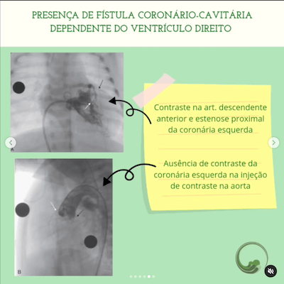 Fistula coronário cavitaria atresia pulmonar com septo integro wavesmed