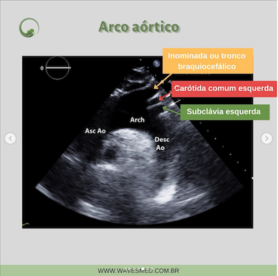 Arco aórtico anatomia da aorta wavesmed