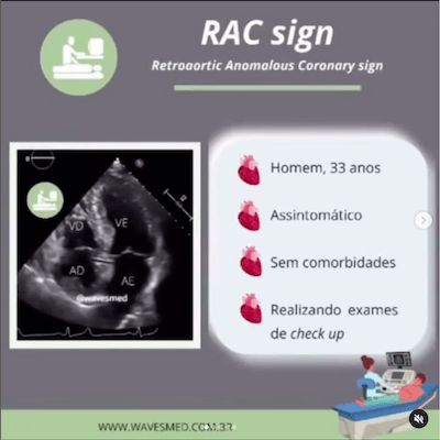 RAC sign ecocardiograma wavesmed