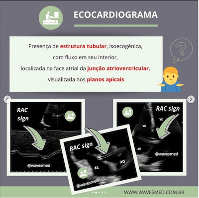 Junção atrioventricular RAC sign ecocardiograma wavesmed