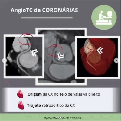 Angio tc coronárias RAC sign ecocardiograma wavesmed