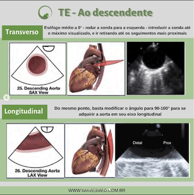 ETE doenças da aorta janelas ecocardiográficas avaliação da aorta wavesmed