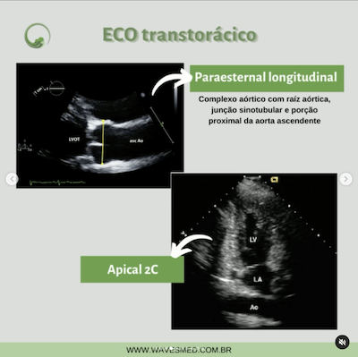 Paraesternal longitudinal doenças da aorta janelas ecocardiográficas avaliação da aorta wavesmed