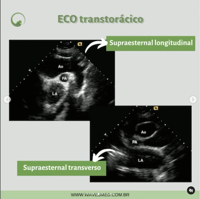 Aorta supraesternal doenças da aorta janelas ecocardiográficas avaliação da aorta wavesmed