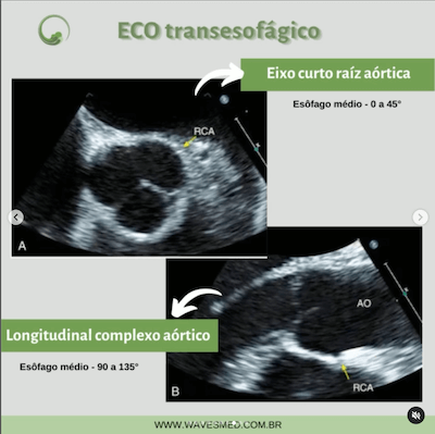 Esofágico doenças da aorta janelas ecocardiográficas avaliação da aorta wavesmed