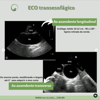 Transesofagico longitudinal doenças da aorta janelas ecocardiográficas avaliação da aorta wavesmed