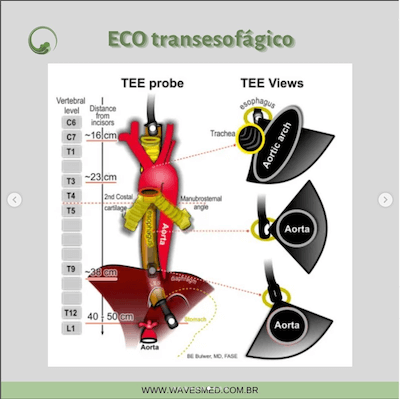 ETE doenças da aorta janelas ecocardiográficas avaliação da aorta wavesmed