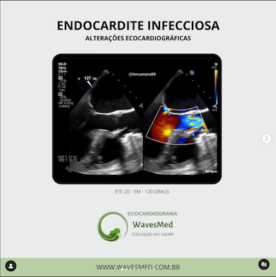 Ecocardiograma Endocardite Infecciosa wavesmed