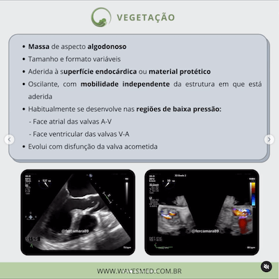 Vegetação ecocardiograma endocardite infecciosa wavesmed