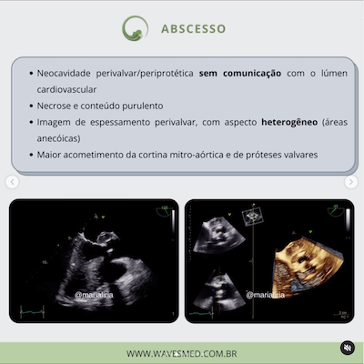 Abscesso ecocardiograma endocardite infecciosa wavesmed