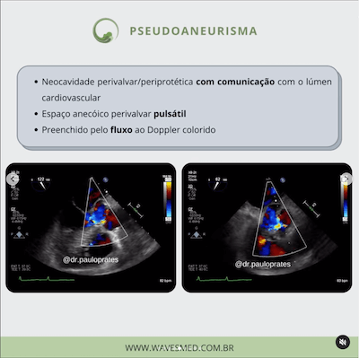 Pseudoaneurisma ecocardiograma endocardite infecciosa wavesmed