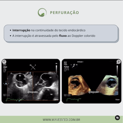 Perfuração ecocardiograma endocardite infecciosa wavesmed