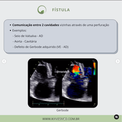 Fistula ecocardiograma endocardite infecciosa wavesmed