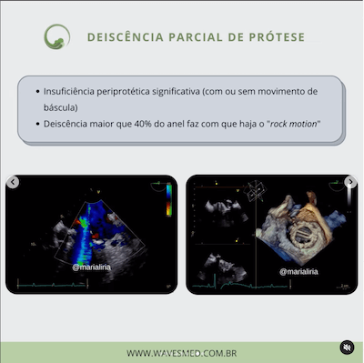 Deiscência ecocardiograma endocardite infecciosa wavesmed