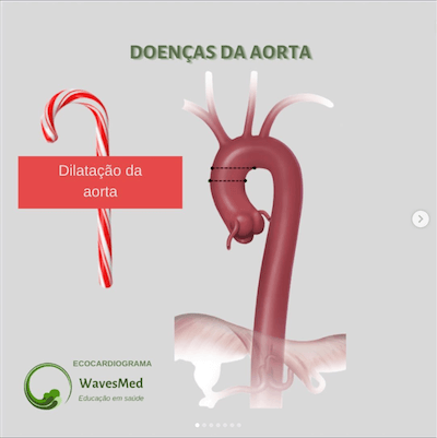 Como medir dilatação aorta ecocardiograma wavesmed