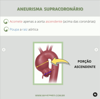 Aneurisma supracoronário como medir dilatação aorta ecocardiograma wavesmed