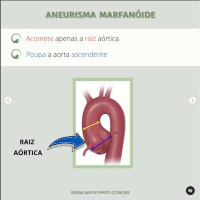 Aneurisma marfanôide como medir dilatação aorta ecocardiograma wavesmed