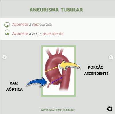 Aneurisma como medir dilatação aorta ecocardiograma wavesmed