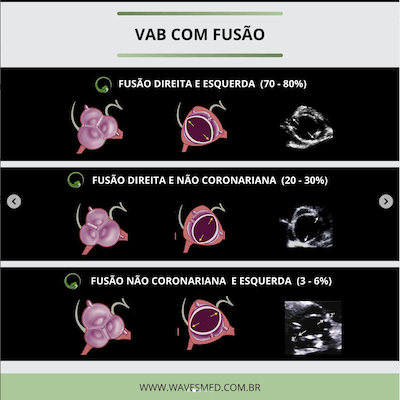 Fusão comissural valva aórtica bivalvular wavesmed