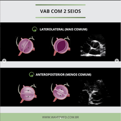 Laterolateral valva aórtica bivalvular wavesmed