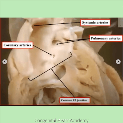 Anatomia tac tronco arterial comum wavesmed