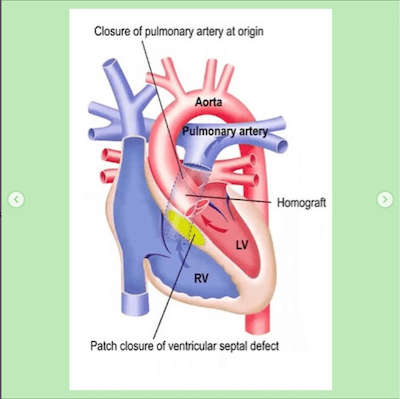 Tac tronco arterial comum wavesmed