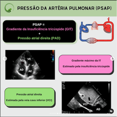 Pressão artéria pulmonar ecocardiograma como cateter swan ganz wavesmed