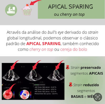 Apical sparing amiloidose cardíaca wavesmed