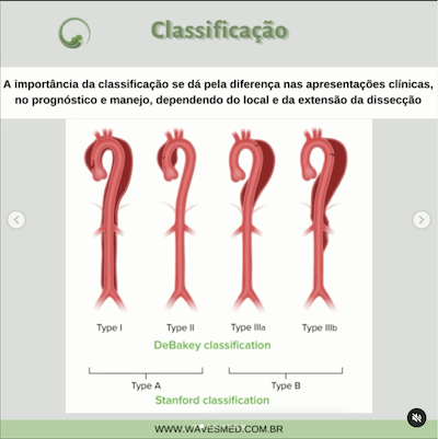 Classificação dissecção de aorta wavesmed