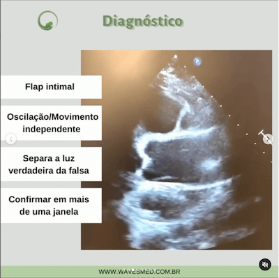 Diagnostico dissecção de aorta wavesmed