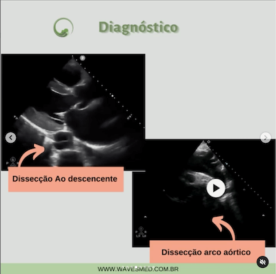 Diagnostico arco aórtico dissecção de aorta wavesmed