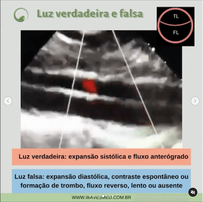 Luz verdadeira luz falsa dissecção de aorta wavesmed