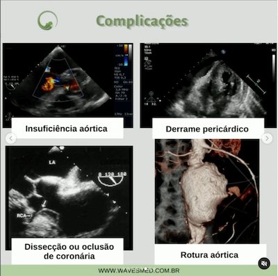 Complicações dissecção de aorta wavesmed