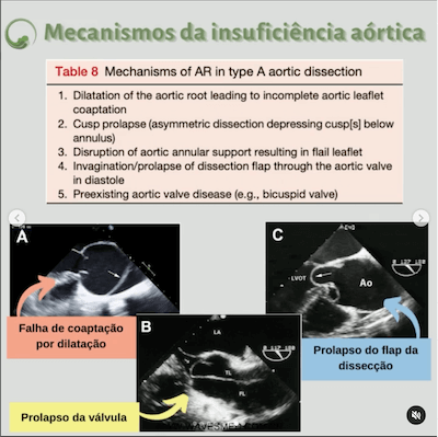 Mecanismos insuficiência aórtica dissecção de aorta wavesmed