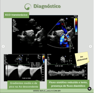 Ecocardiograma Coarctação Aorta Wavesmed