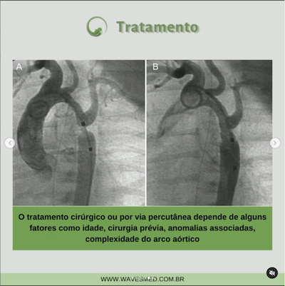 Cateterismo Coarctação Aorta Wavesmed