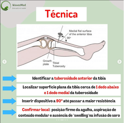 Técnica Acesso Intra osseo Wavesmed