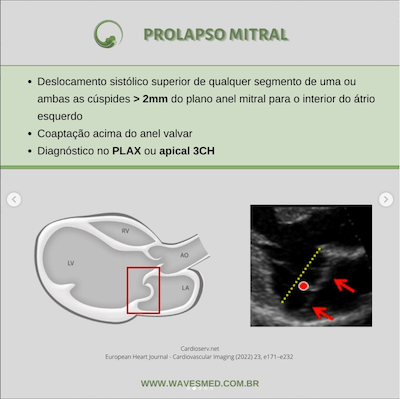 Definição Prolapso Valvar Mitral Wavesmed